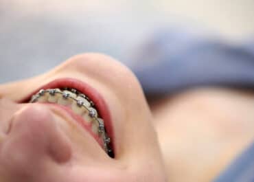 Jak dbać o higienę jamy ustnej po założeniu aparatu ortodontycznego?