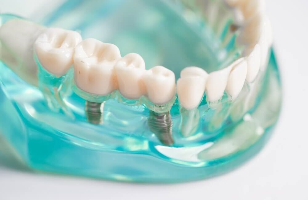 jak wybrać implanty zębowe