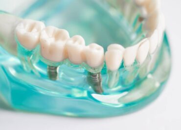 Jak wybrać odpowiednie implanty zębowe?